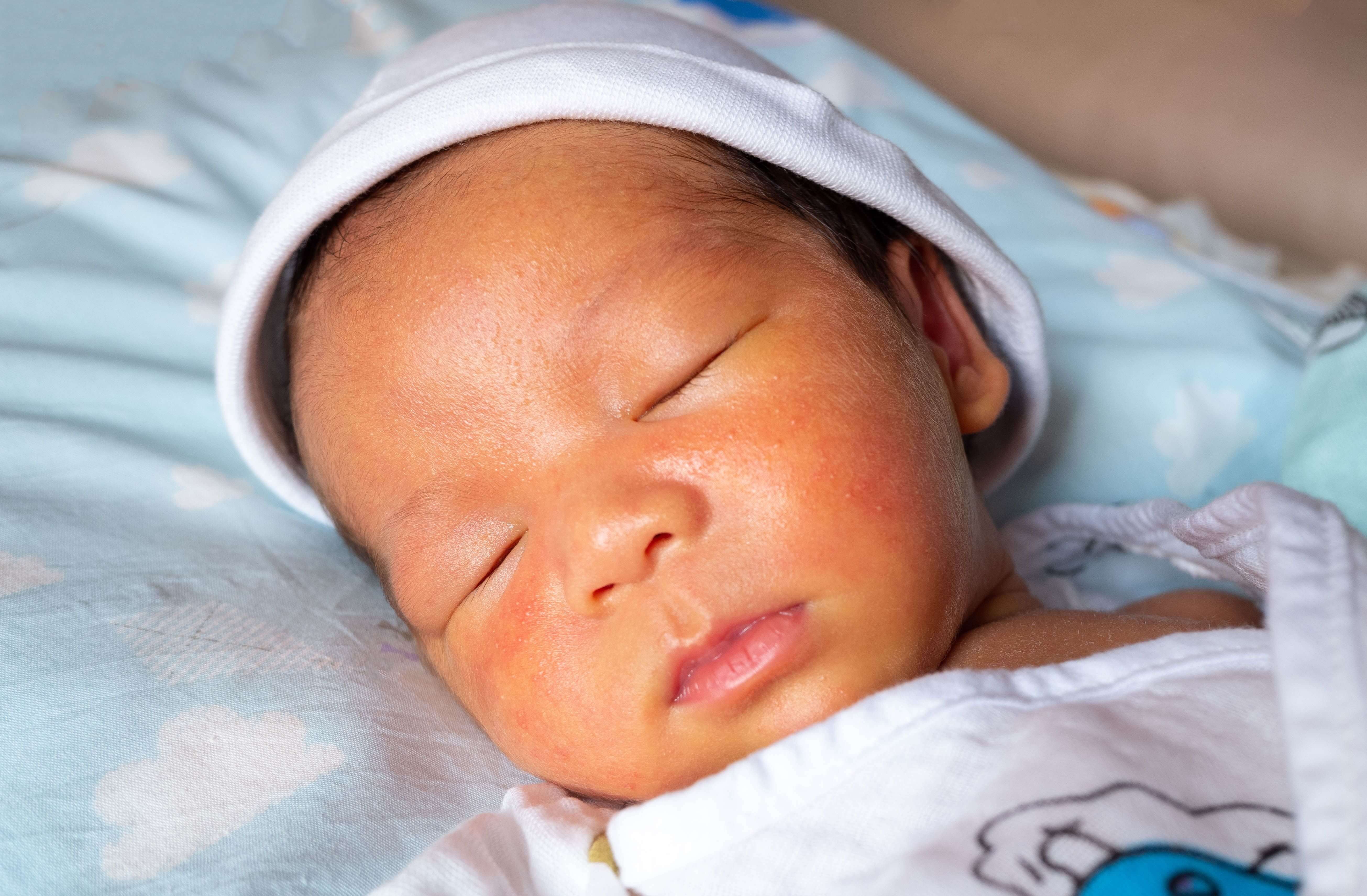 What Is Jaundice: Understanding Its Causes, Symptoms, and Treatment